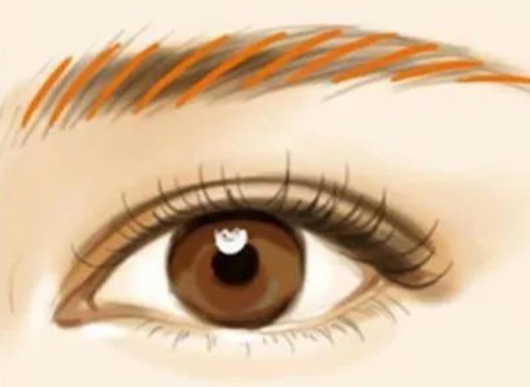 Xóa xăm lông mày bằng Laser Microblading (Xóa xăm lông mày) có để lại sẹo không?