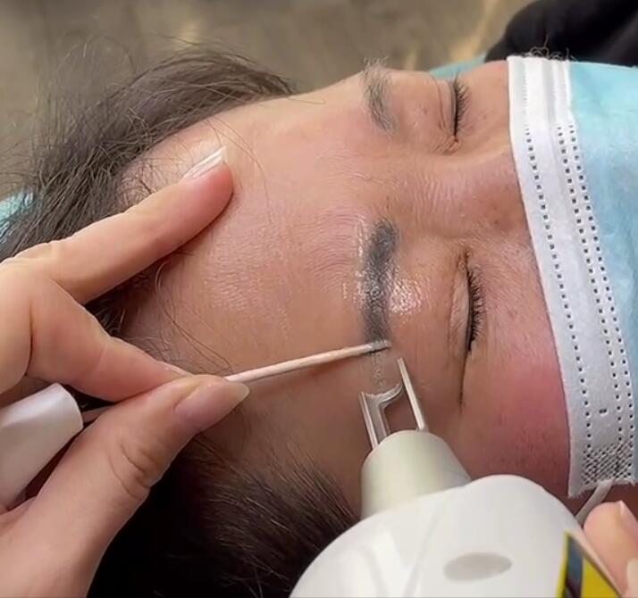 Chúng ta nên chú ý đến những gì trước và sau khi loại bỏ hình xăm lông mày laser?