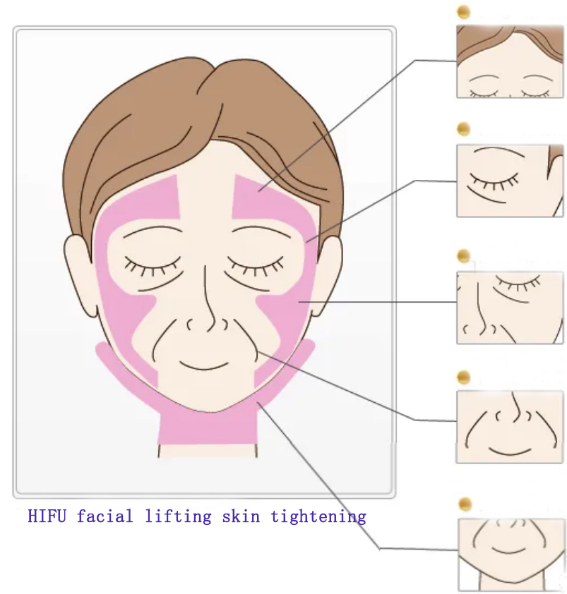 Làm thế nào để vẽ các đường điều trị trước khi điều trị nâng mặt HIFU để tránh tổn thương da?